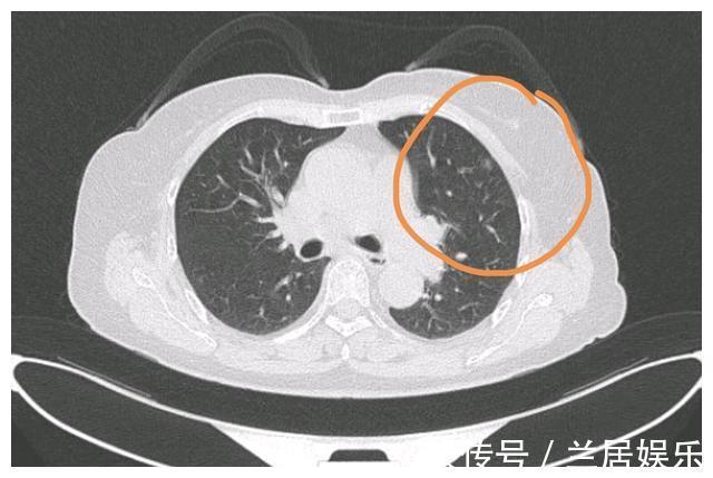 癌症|北大人民医院刘医生父亲查出了肺癌，希望放弃治疗，我没同意