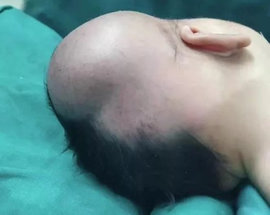 产妇|孕妈客厅散步,宝宝突然“钻”了出来,头朝地摔在地上,万幸!