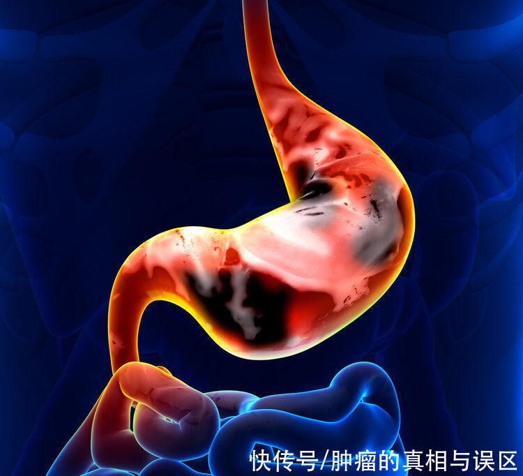 多年的老胃病会发展成胃癌吗？4种慢性胃病，癌变风险较高