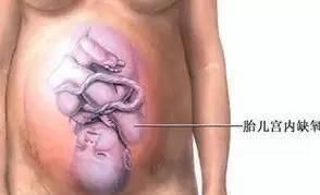 凶险性|分娩时,出现以下8种情况的产妇务必选择剖腹产,千万别犹豫误事