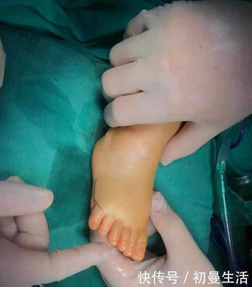 畸形|新生儿出生后有6个脚趾,医生在指尖“绣花”,网友:巧夺天工