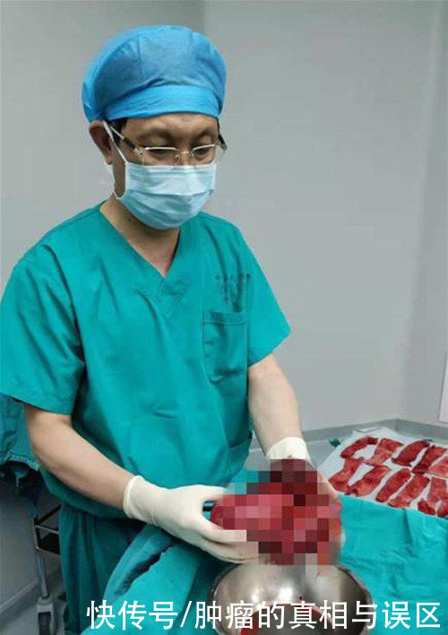 元凶|女子剧烈腹痛，“元凶”竟是腹内20cm大肿瘤，这个病例值得警惕