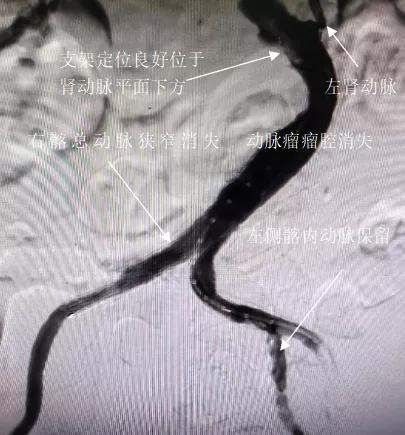 咸阳市|80岁老人腹中藏“不定时炸弹”，咸阳市第一人民医院微创精准拆除