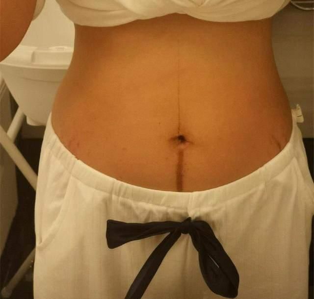 怀孕期间|女性怀孕之后为什么肚子上会有个“黑线”呢？它的出现又代表着什么
