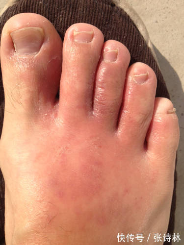 用药|慢性湿疹用什么湿疹膏好 科学用药安全护理