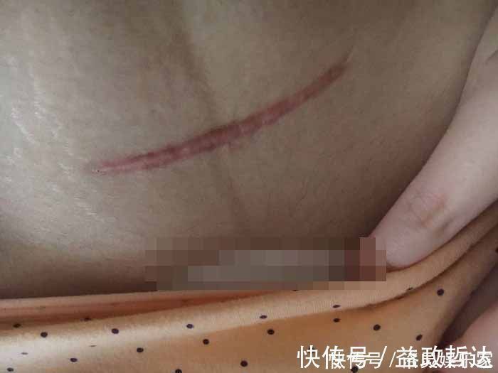 产科医生|剖腹产没半年又怀孕,孕30周后子宫破裂,大人保住了孩子却没了