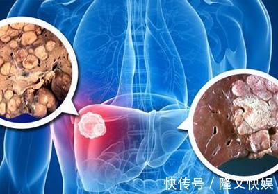 肝细胞|肝毒终于碰到了“死对头” ,坚持吃一点,排净肝毒,肝病从此不来扰