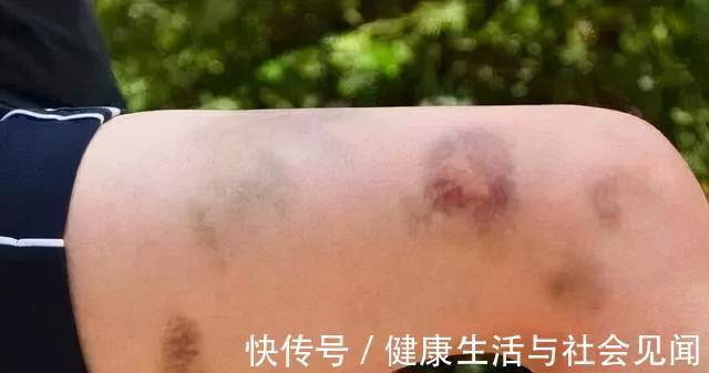 胰腺癌|癌症来临前,身体已经提醒你9次,还是很多人一次次错过了,如何科学预防癌症?