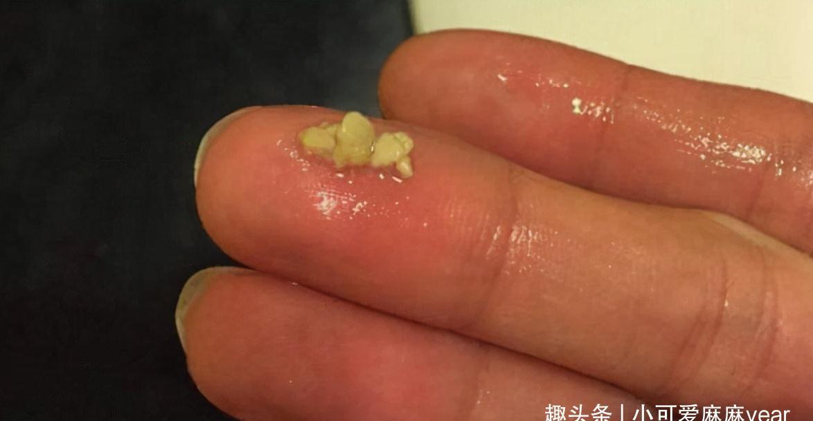 同学|6岁男孩因“口臭”被同学嫌弃,送医检查后,护士都没忍住呕吐