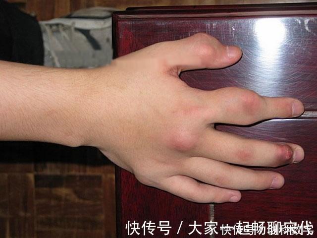 嘌呤|他喝酒50年，自称不怕痛风，秘诀只有1个，尿酸保持得好