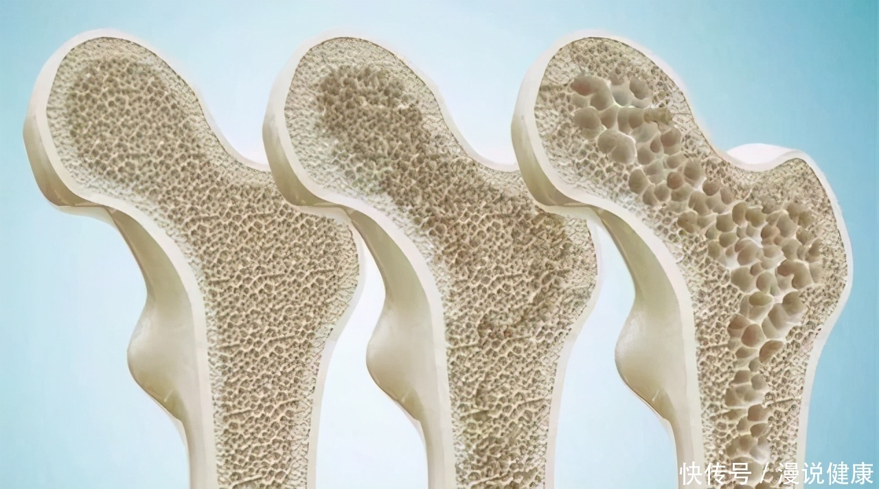 老年人|掰手腕突然骨折?为何现在年轻人的骨质疏松,要比老年人还严重?