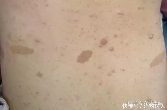 甲床下纤维瘤|我从出生身上皮肤就有颜色不一的情况是结节硬化症问题么?