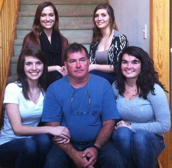 胎记|17岁姑娘满身胎记,从小被人嘲笑,妈妈这是上帝留下的吻痕