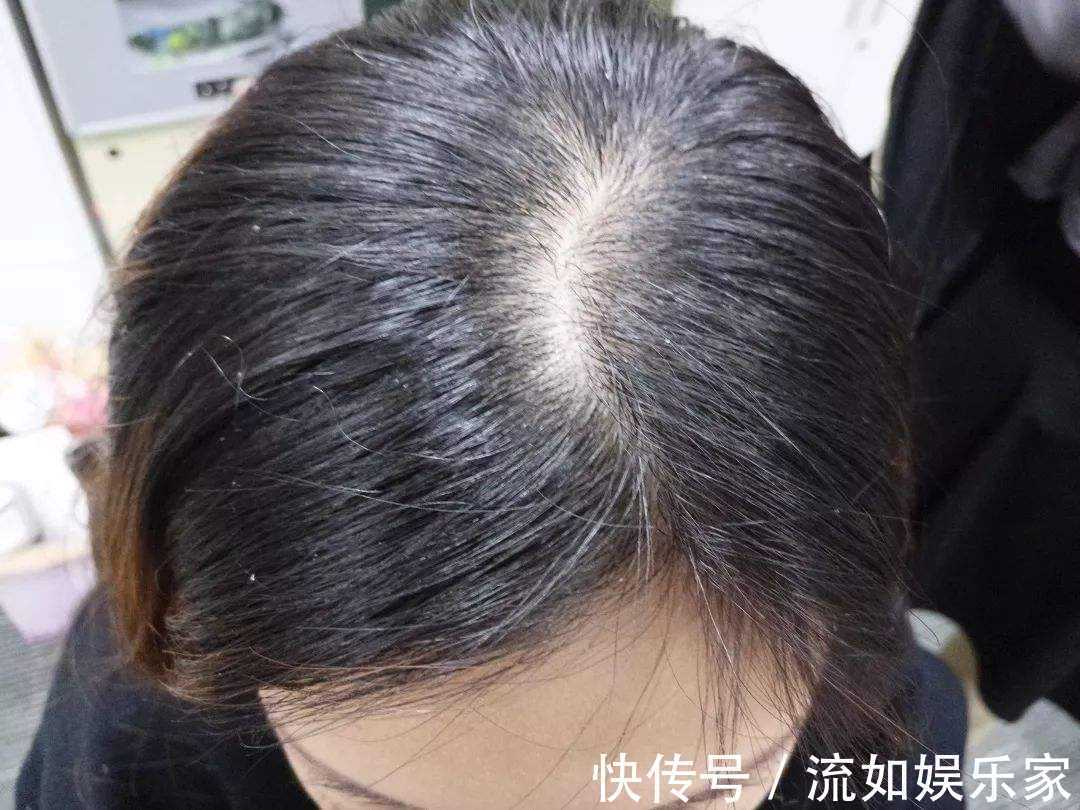 辛辣刺激|医生提醒 脱发是你亲手喂出来的，4种食物不忌嘴，迟早成地中海