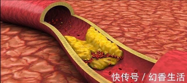 高血脂|高血脂的“祸根”不只是盐,劝告3物最好少吃,不然血脂飙升