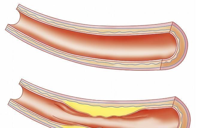 动脉粥样硬化|发现“动脉斑块”,还能逆转或消失吗心脏医生给出靠谱答复
