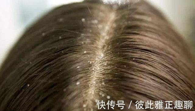 螨虫|浙江女性坚持用“硫磺皂水”洗头发,后来得到了啥?多数人想不到