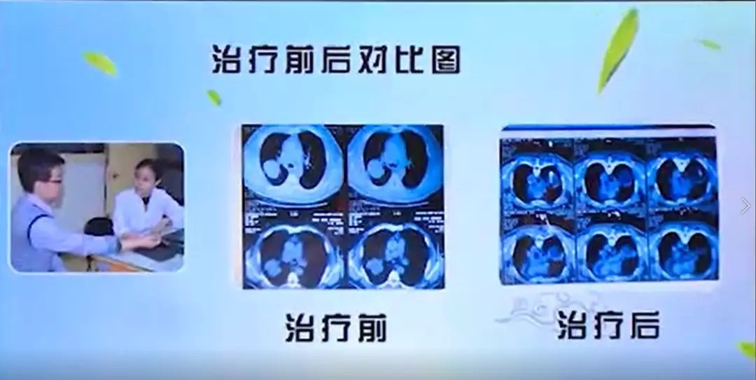 肺結節|肺結節2個誤區要避開，警惕變為肺癌！中醫外敷內服法消散結節