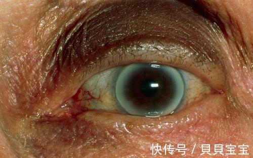 身体|提醒：身体出现6个变化，暗示血脂已经升高，很多人容易忽视