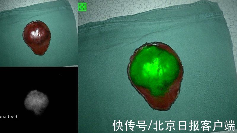 胆汁|让手术更精准！首儿所首次应用这项技术为5岁患儿切除肿瘤