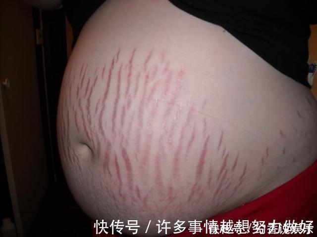 皮肤|女明星生孩子为什么没有妊娠纹,做好这6点你也可以拒绝西瓜肚
