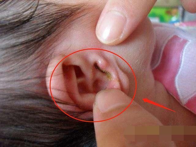 中耳炎|2岁儿子总摸头,妈妈觉得不对劲带娃去检查,医生感叹幸亏发现早