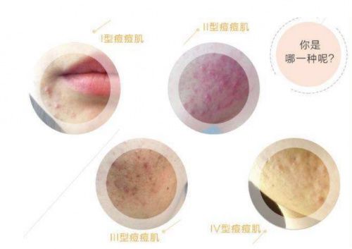 痤疮|拒绝做“痘女郎”，这些年你的祛痘方式对了吗？