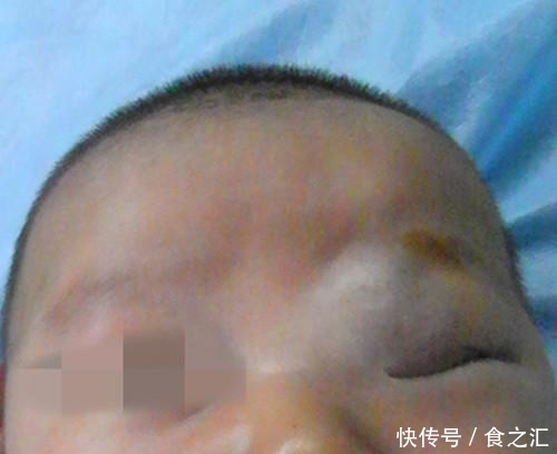 宝宝脸上是海绵状血管瘤吗?家长只要看是否出现这些症状