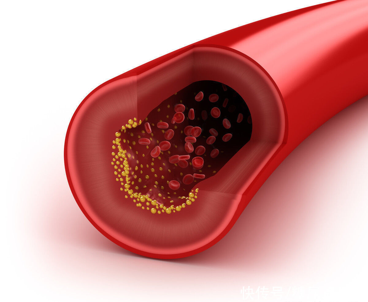 牛奶|糖尿病人喝牛奶好，还是喝豆浆好？营养师帮您正确选择