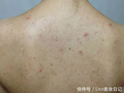 脸颊|皮法师家的它帮你轻松搞定螨虫