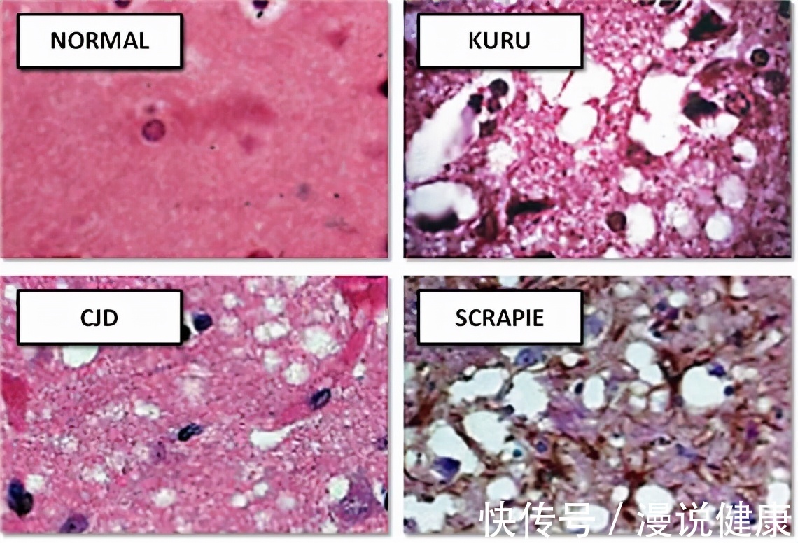 抛开伦理和道德,人肉到底能吃吗?这群食人族,却因遭受“诅咒”