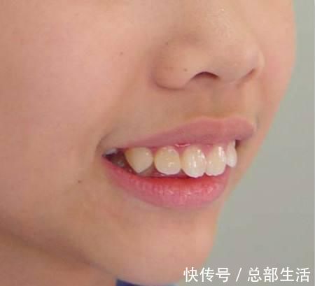 牙科医生|15岁男孩长出“尖牙”,妈妈亲手摸过后吐槽:养了个“吸血鬼”