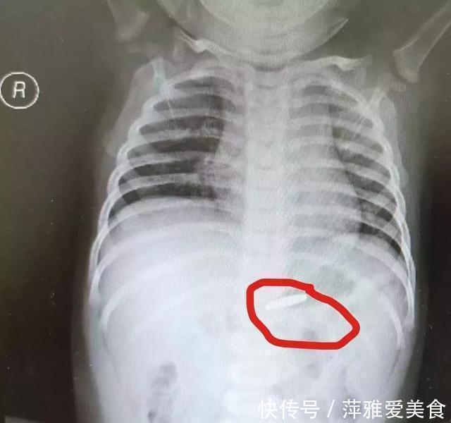 喉咙|小小一枚,孩子喉管被腐蚀!再说一遍,这些东西必须放好了