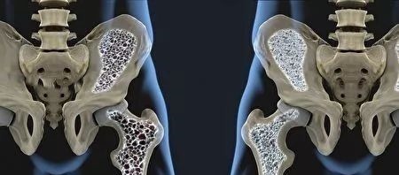 饮食习惯|骨质疏松还在盲目吃钙片先做到这3点,把骨头慢慢“养”好