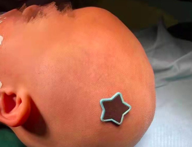 凹陷性骨折|3岁女童一跤摔进ICU,撞碎颅骨、刺破脑膜