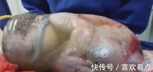 羊膜囊|巴西女子生下“魔力宝宝”,在场所有医生都惊呆了