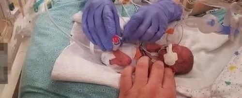 侏儒症|婴儿刚出生就被判侏儒症停止发育，父母不愿放弃如今变成这样！