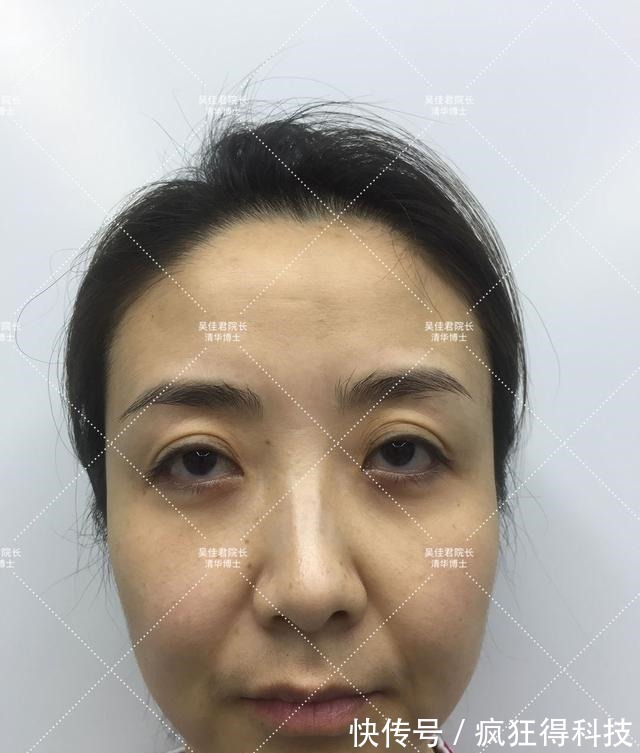 面部 小拉皮术后8个月,她从松垮阿姨脸秒变紧致少女脸!