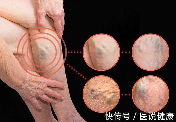 肾脏|肾不好,不能拖!久拖不治易引发5个并发症,要重视起来!