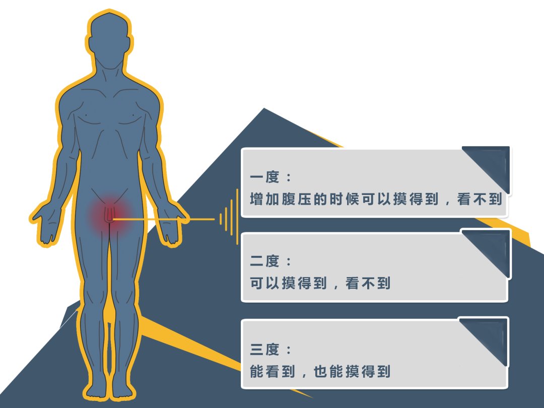 雄激素|一种患病率高达20%，可导致男性不育，却大多无需处理的疾病