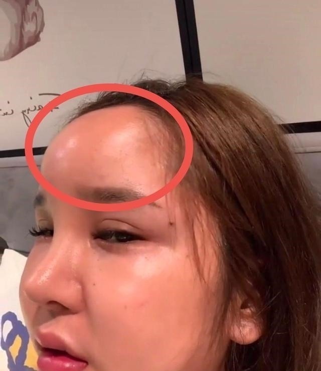 光额头 8年的整形手术花费了100多万,光额头就打了200多支玻尿酸