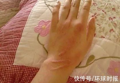 脓液|女子被宠物猫抓了一下，竟得了这种罕见病！身上长出鸡蛋大的肿块