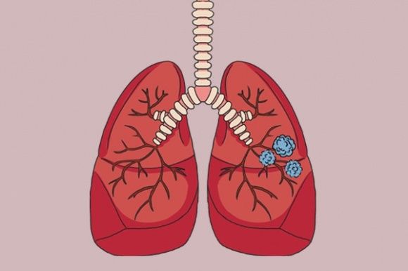 抗癌英雄|身患肺癌十几年仍笑对生活，“抗癌英雄”漆红的一句话，值得学习