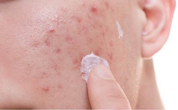 帕芙欧珍肤膏|脸过敏起小米粒怎么办?