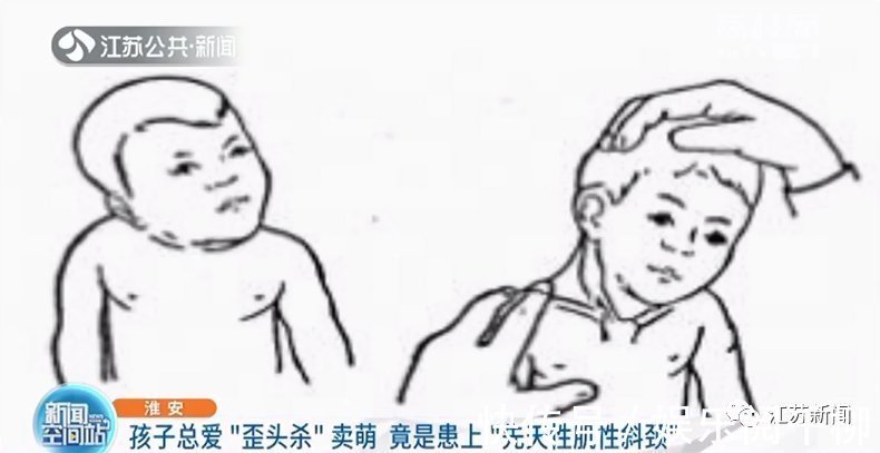 颈部|孩子总爱“歪头杀”卖萌?小心!可能是得了这种病