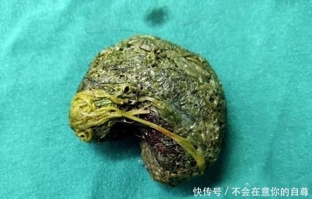 家长|12岁女孩腹痛两年,肚子里出现马蹄形状的团块,都怪家长太粗心