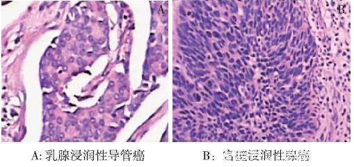 癌症|怀疑自己得癌了，怎么样才能确定自己到底有没有患癌
