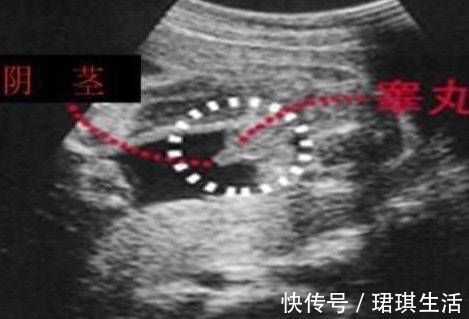 B超|原来男宝宝的B超是这样的，四维彩超单上的暗示，准妈妈你知道吗