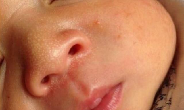 刚出生宝宝鼻子上就长脂肪粒小白点到底是什么