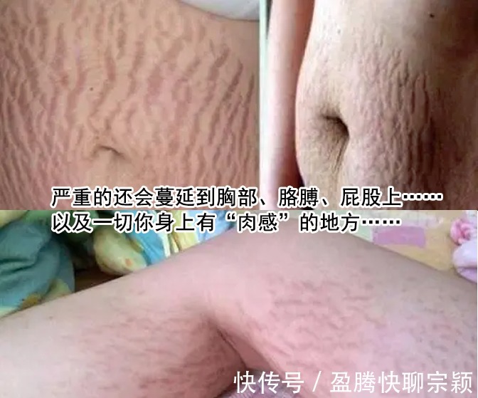 肚子|怀孕趁肚子没大,赶紧预防妊娠纹!别心疼钱,比产后修复划算多了